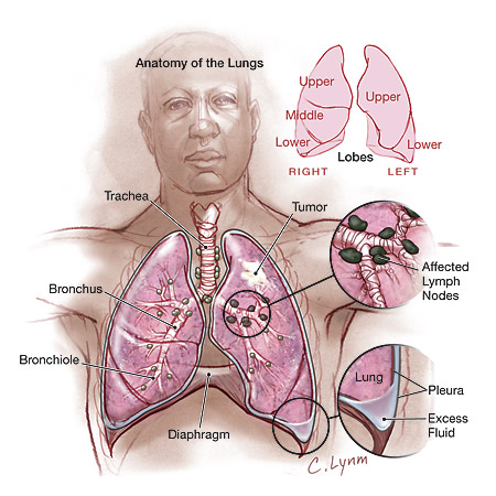 Sample essays on lung cancer