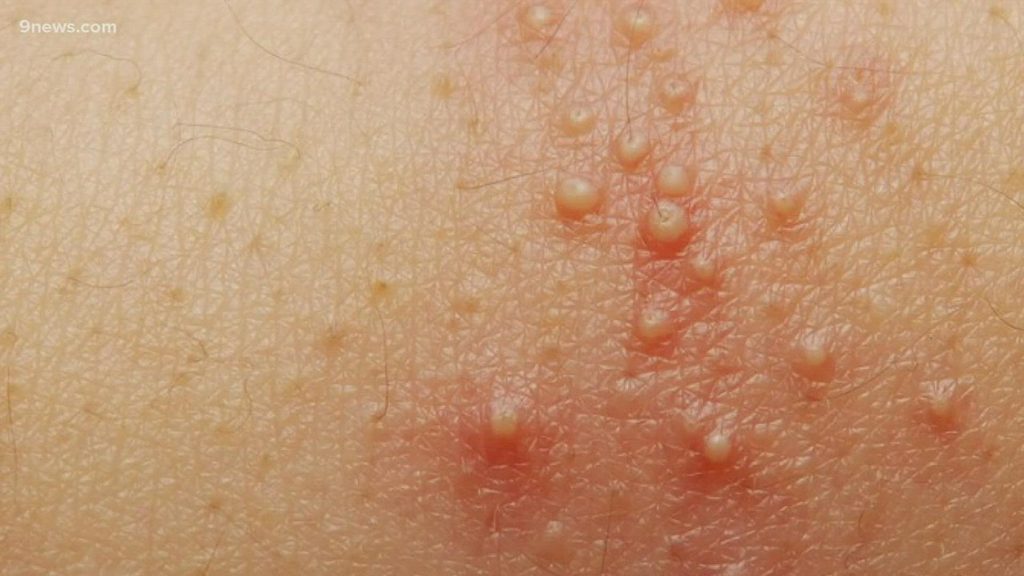measles on skin