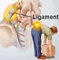 lumbar strain