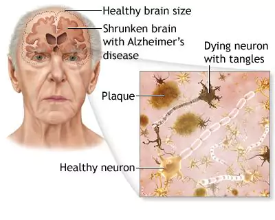 diagram of Alzheimer's Disease