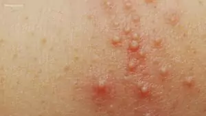 measles on skin